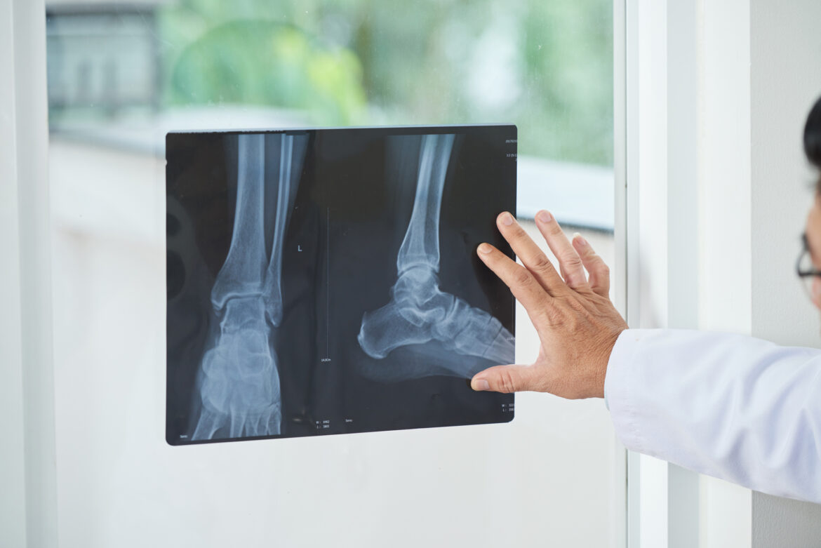 Ankle X-Ray Ankle X-Ray